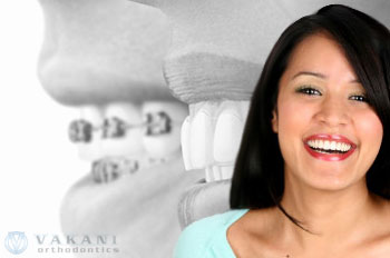 types of braces